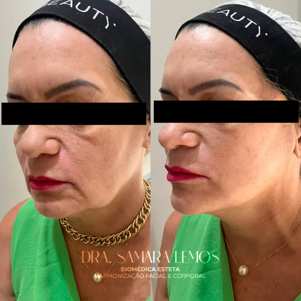 Antes e depois 1