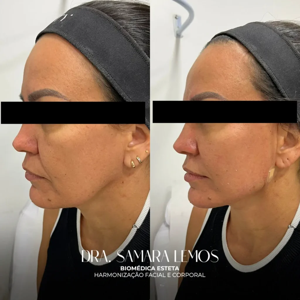 Antes e depois 2