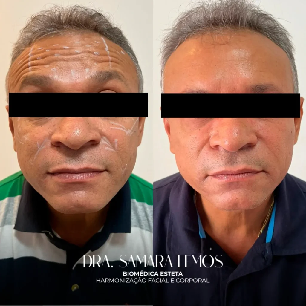 Antes e depois 3