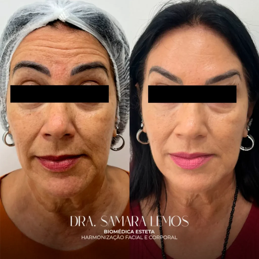 Antes e depois 4