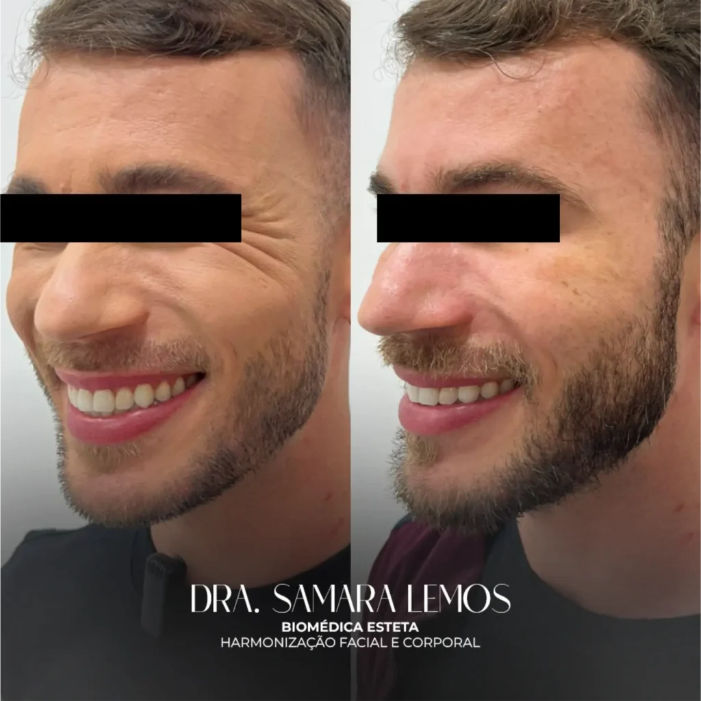 Antes e depois 5